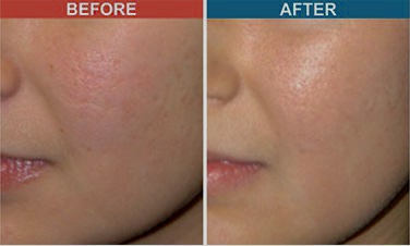 Diode Laser for Vascular Before and After
